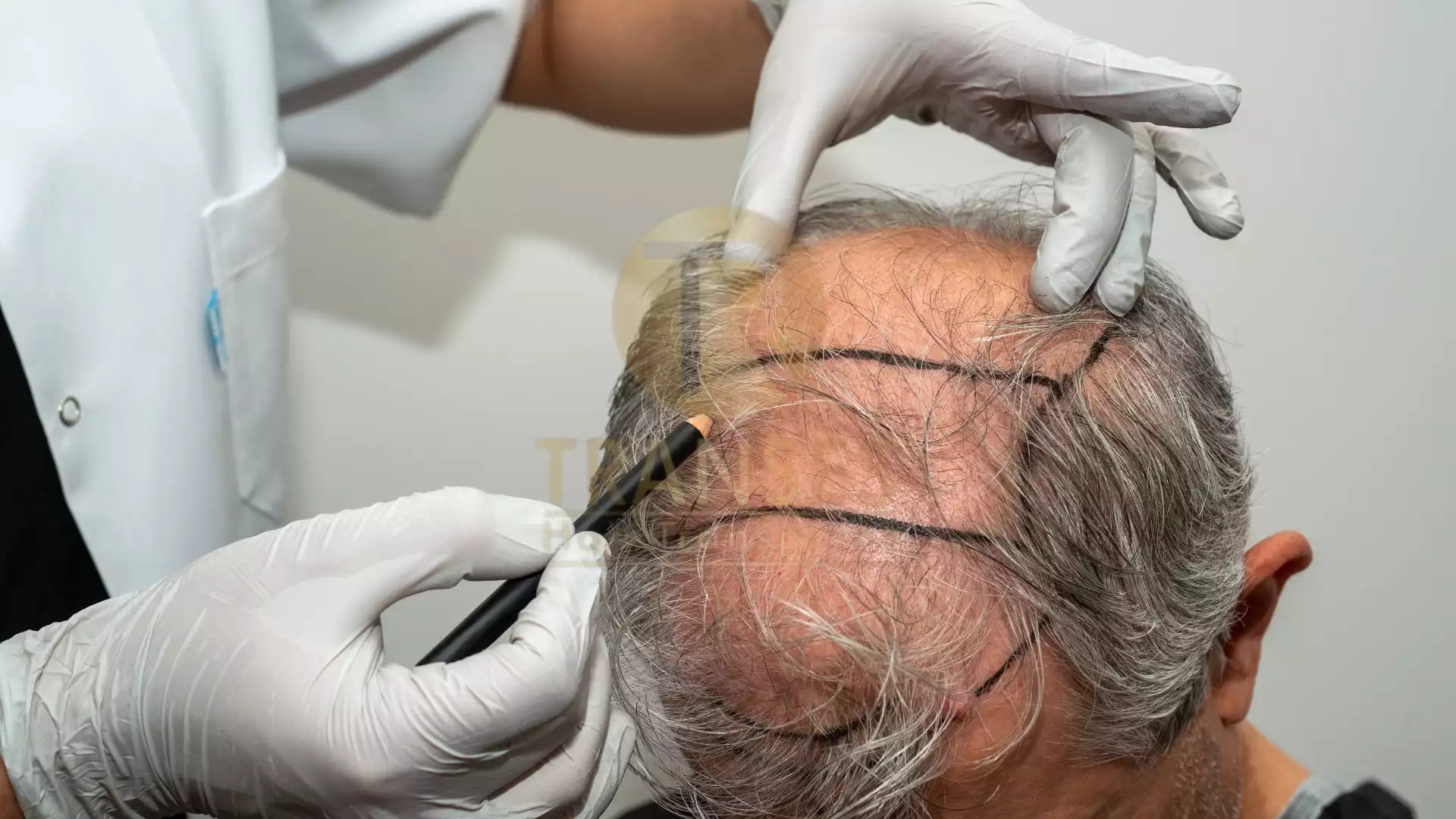 Percutaneous Hair Transplantation