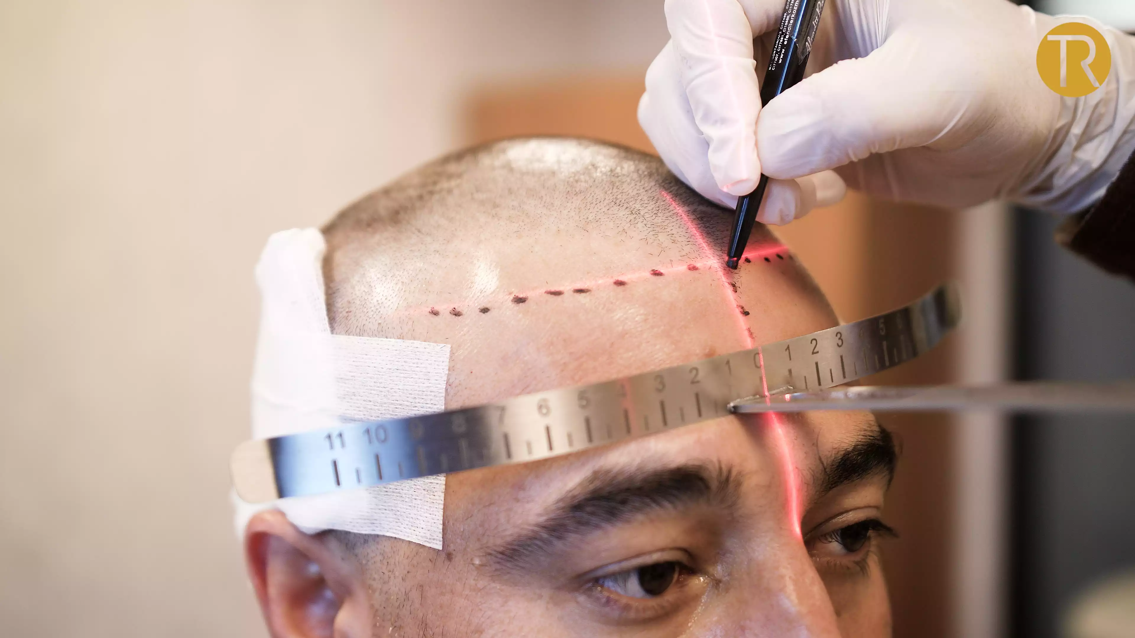 What Is Cloning Hair Transplant? Is It Possible?