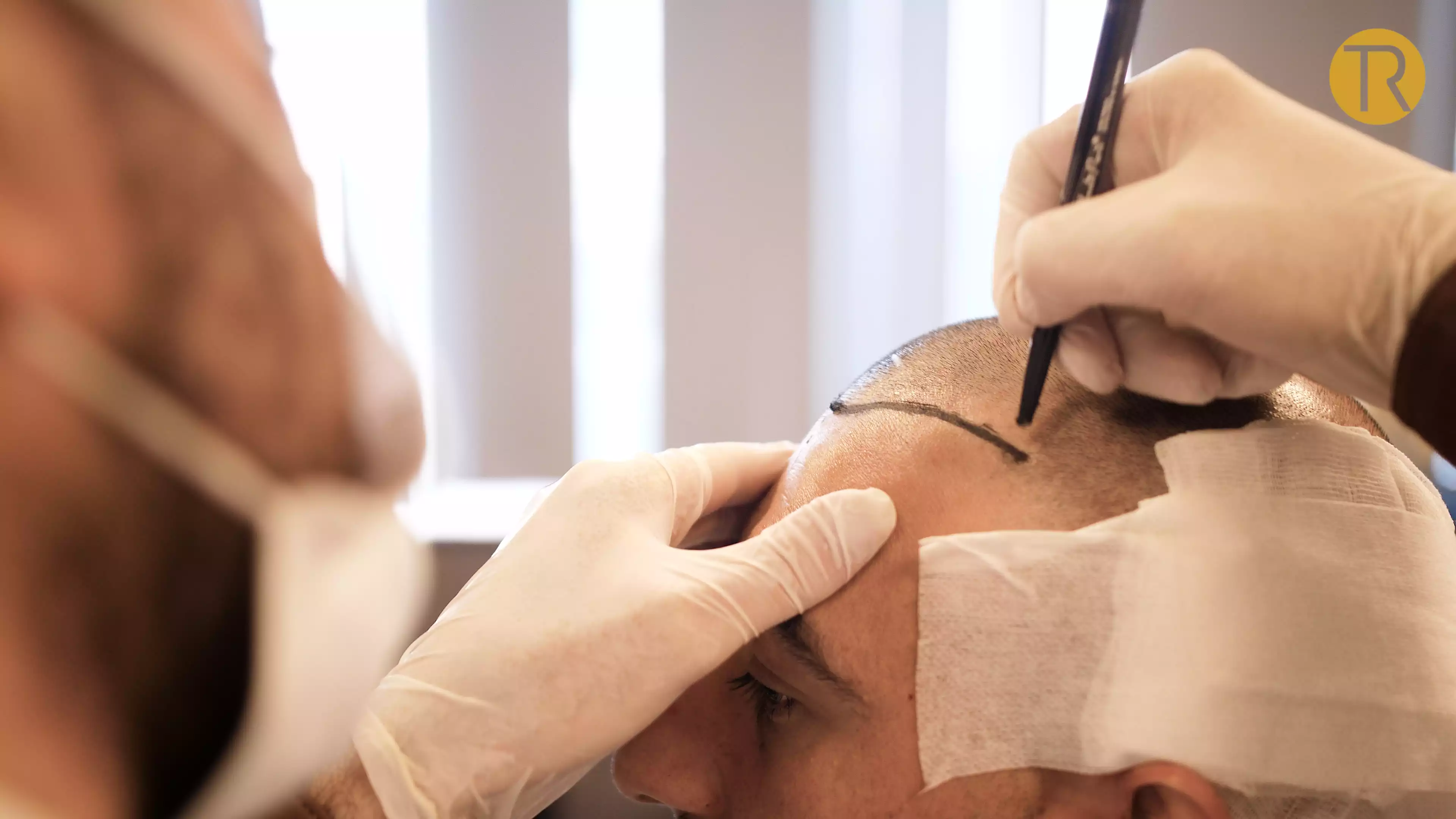 Whose Hair Follicles Are Used in Hair Transplant Surgery?