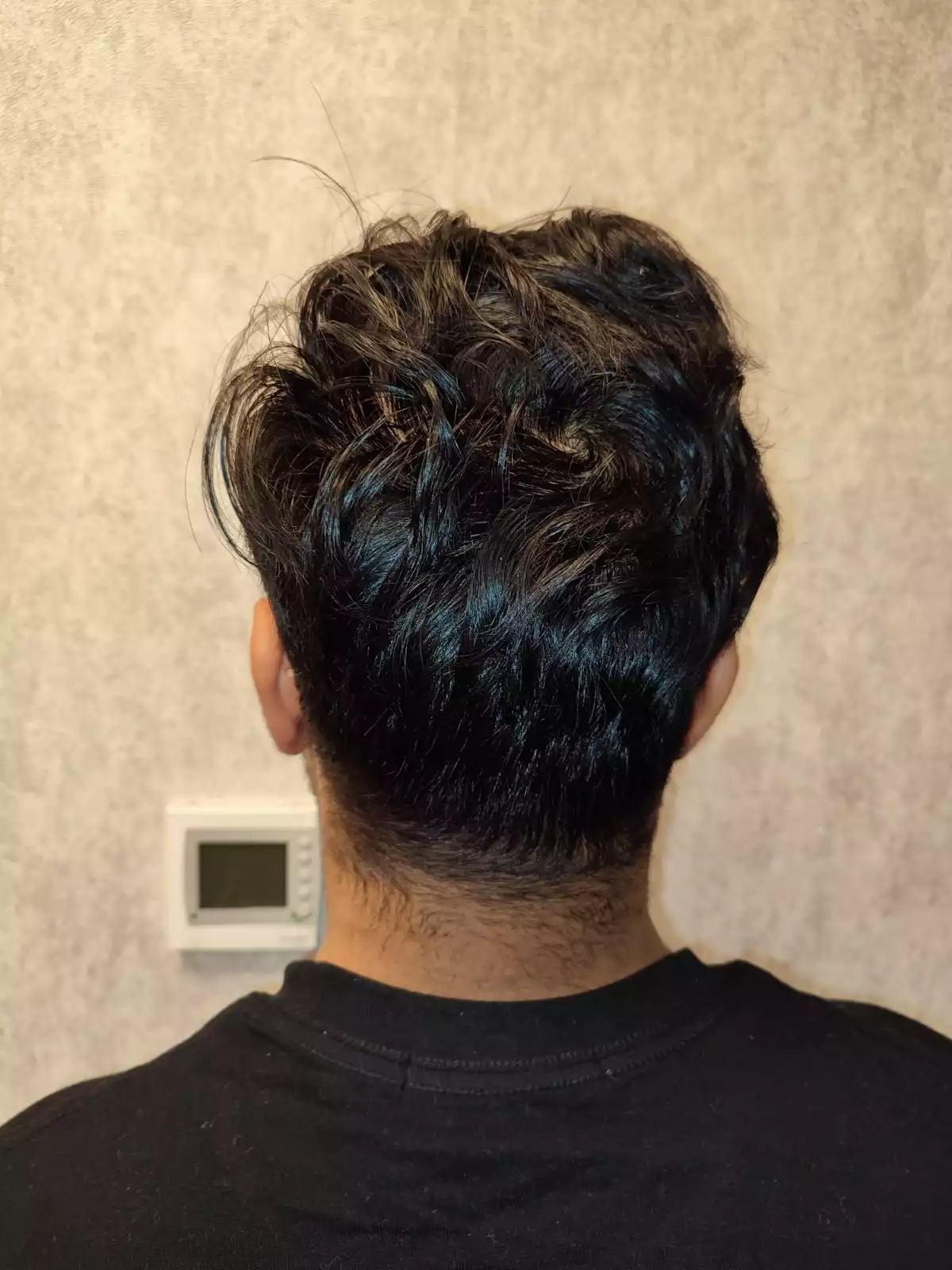 Afro Hair Transplant
