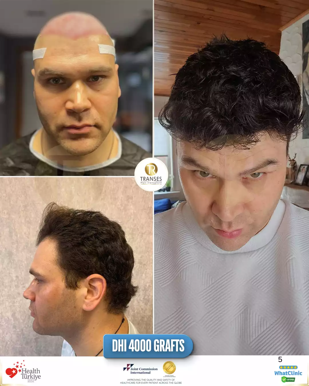 DHI Direct Hair Transplant
