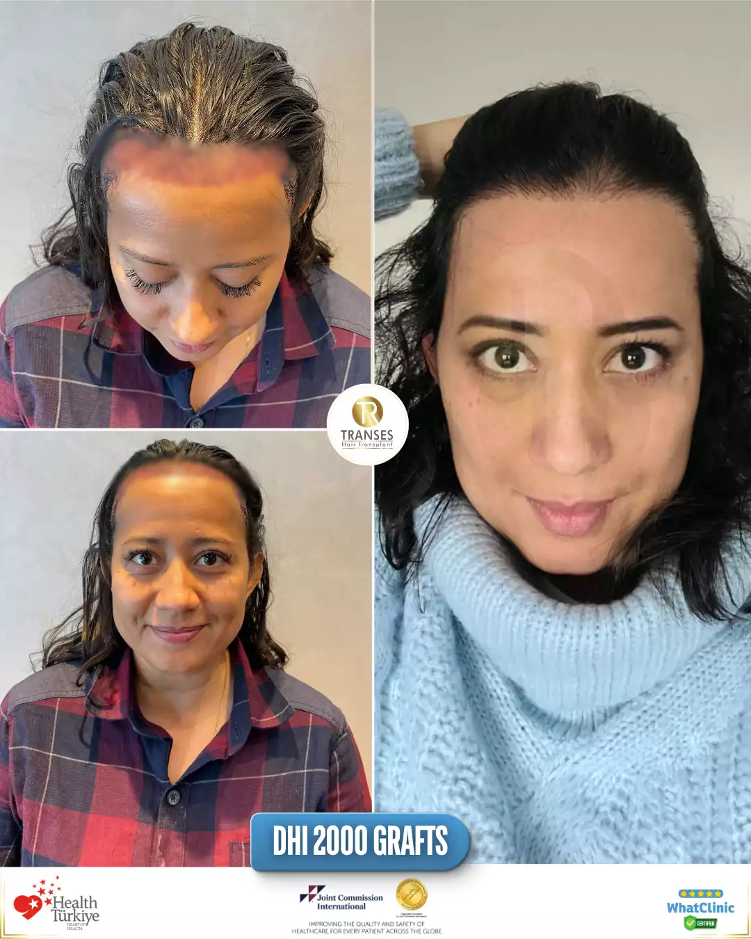 Women's Hair Transplant