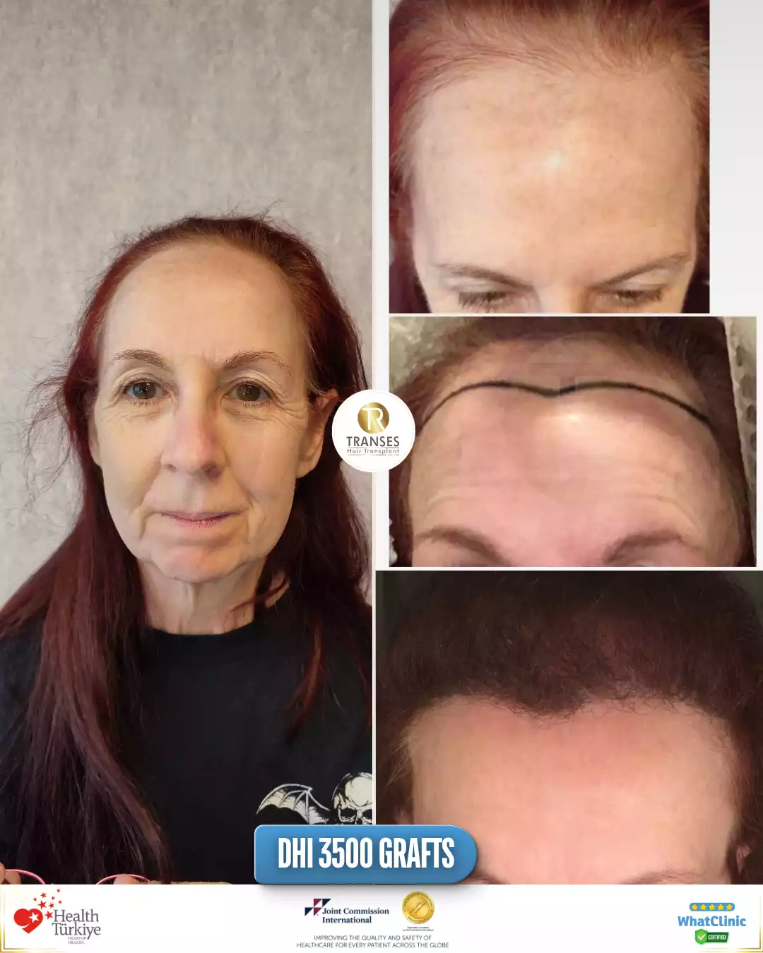Women's Hair Transplant