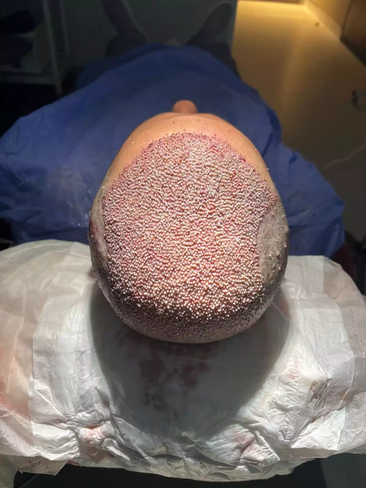 DHI Direct Hair Transplant