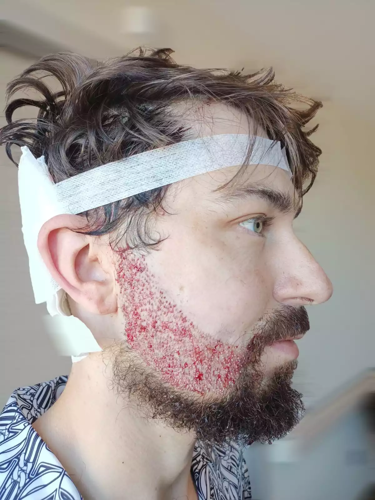 Beard Transplant