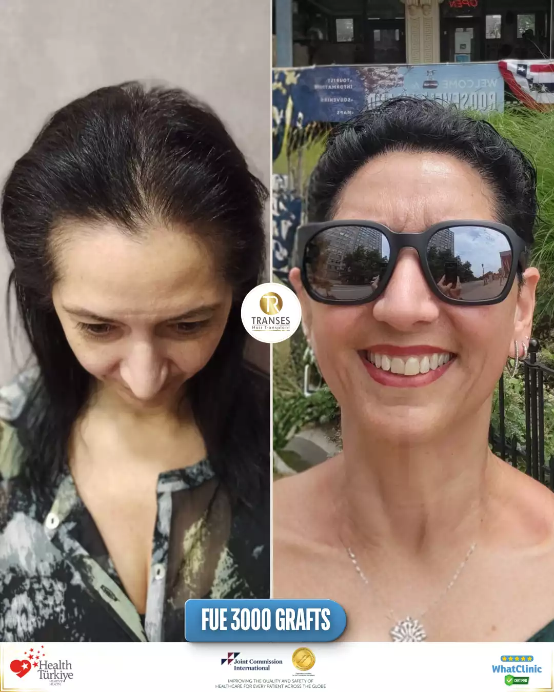 Women's Hair Transplant