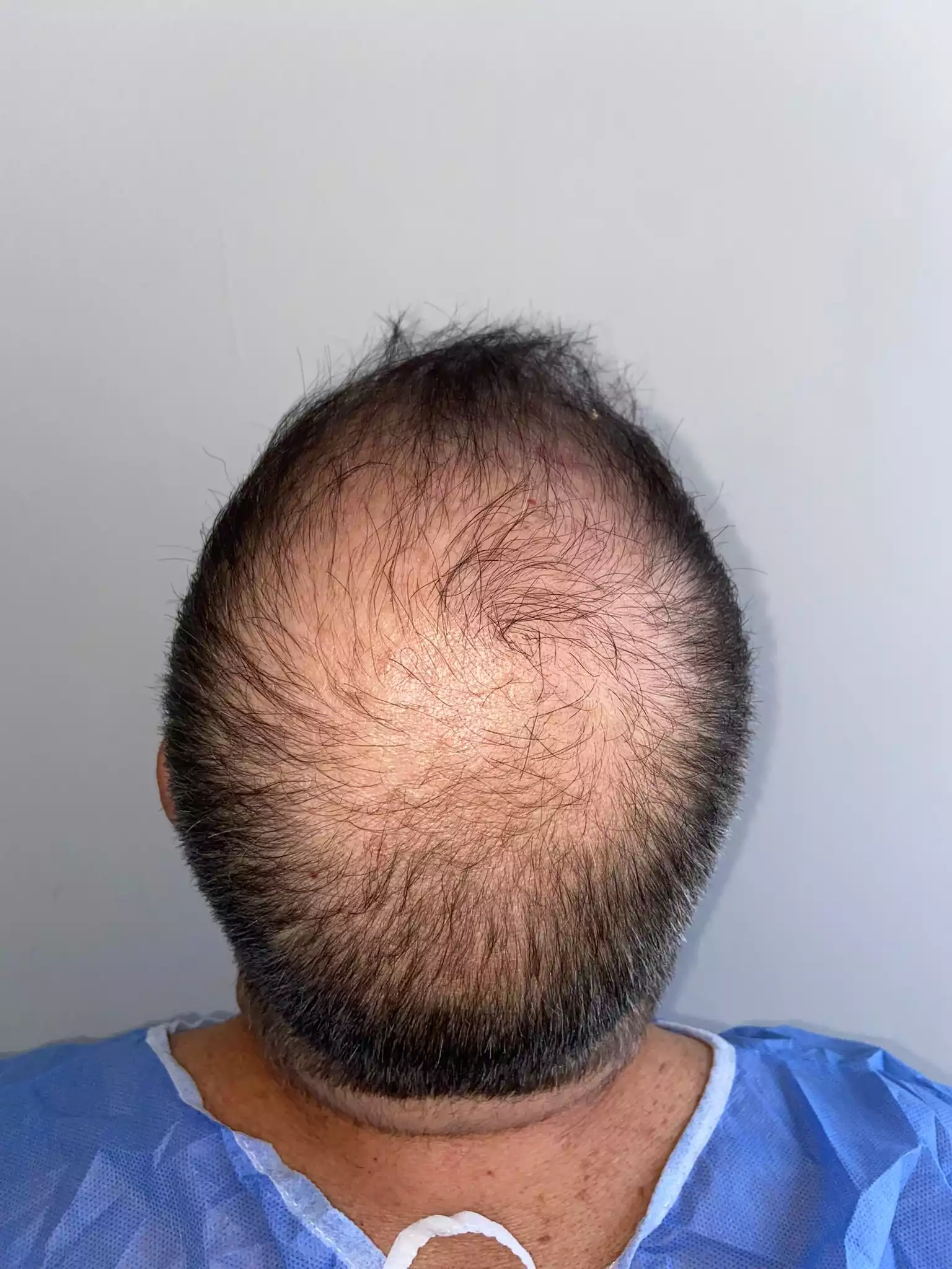 Afro Hair Transplant