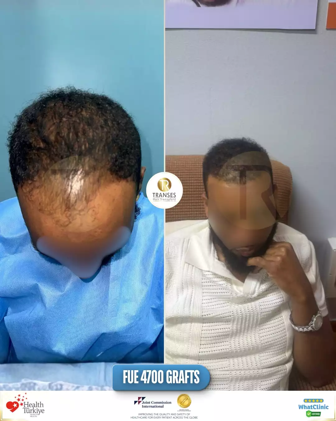 Afro Hair Transplant