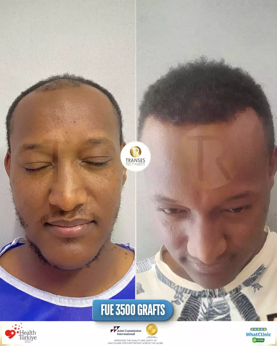 Afro Hair Transplant