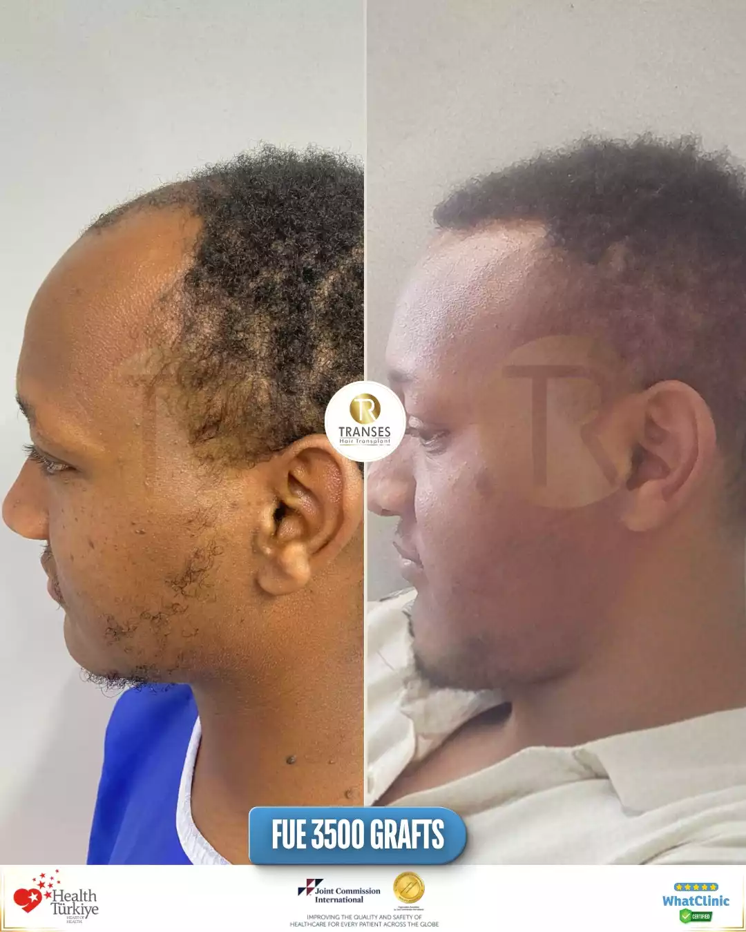 Afro Hair Transplant