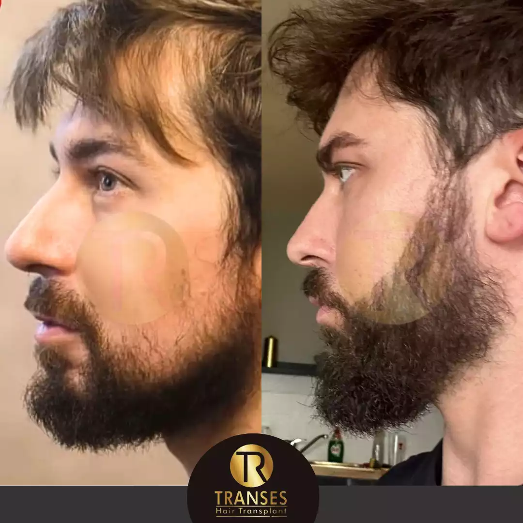 Beard Transplant
