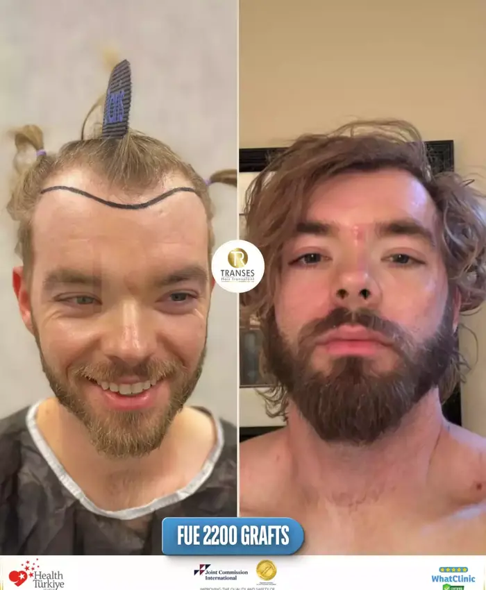 Before & After