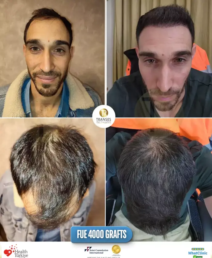 Before & After