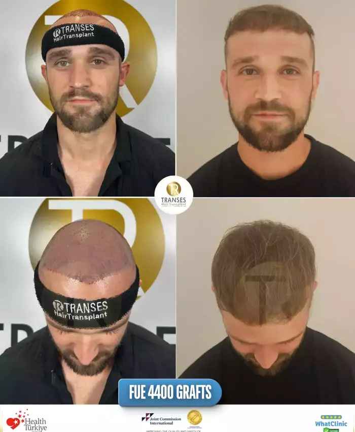Before & After