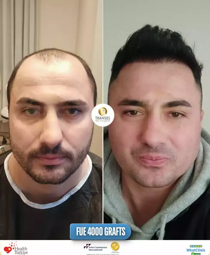 Before & After