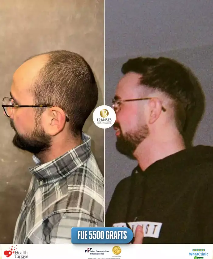 Before & After