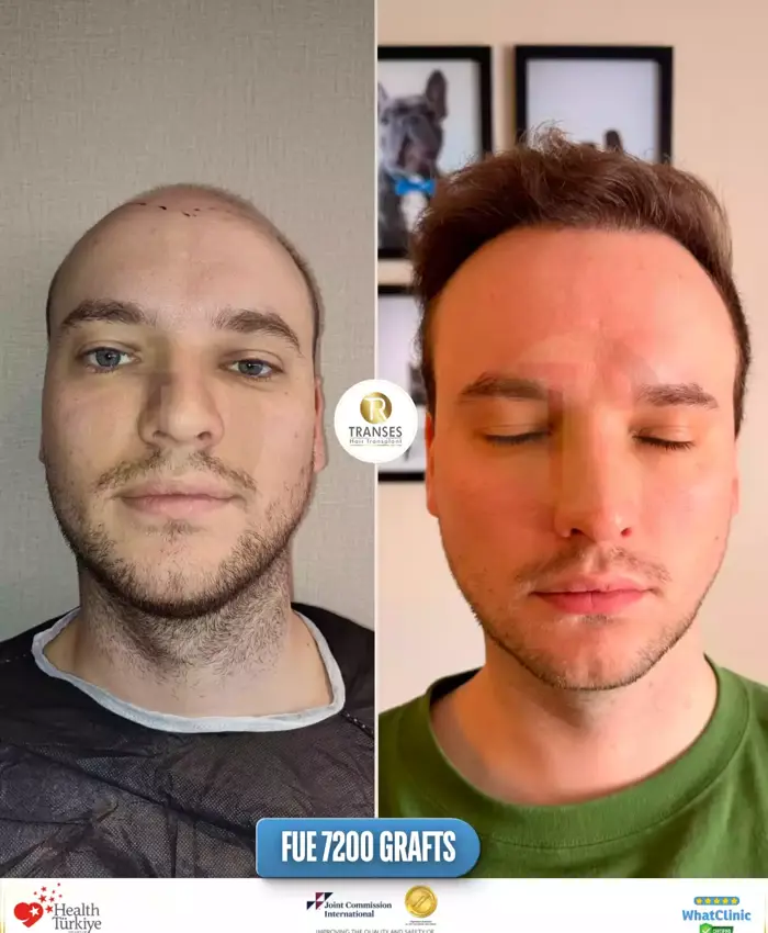 Before & After