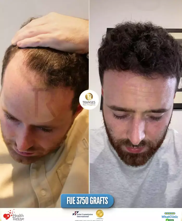 Before & After