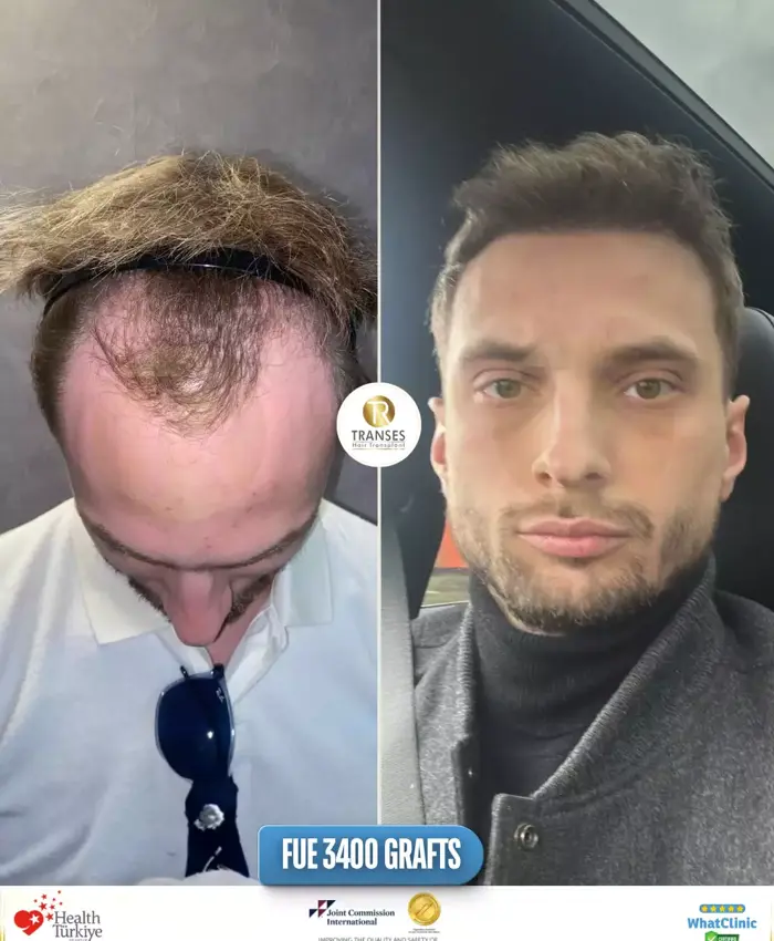 Before & After