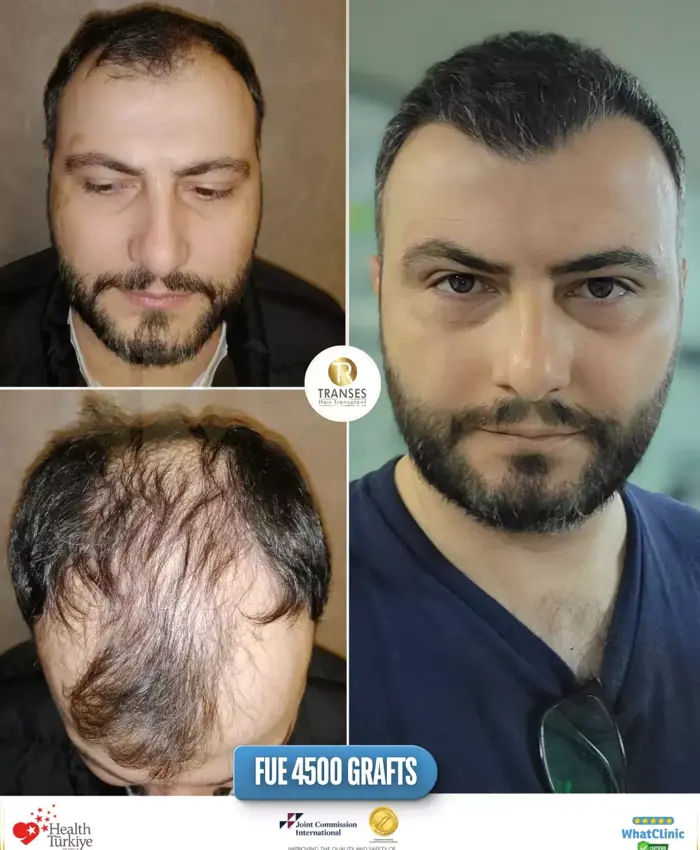 Before & After