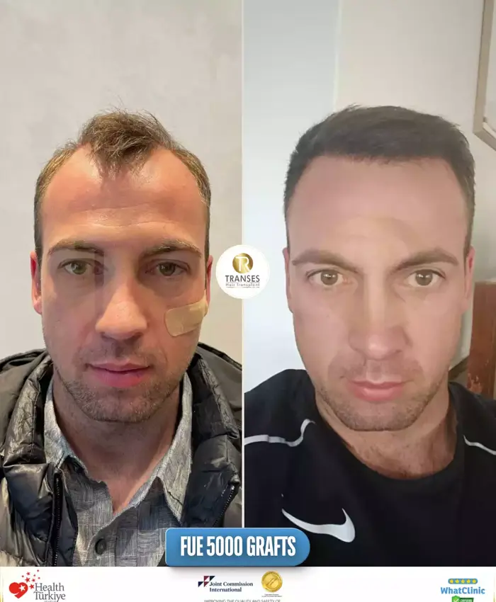Before & After