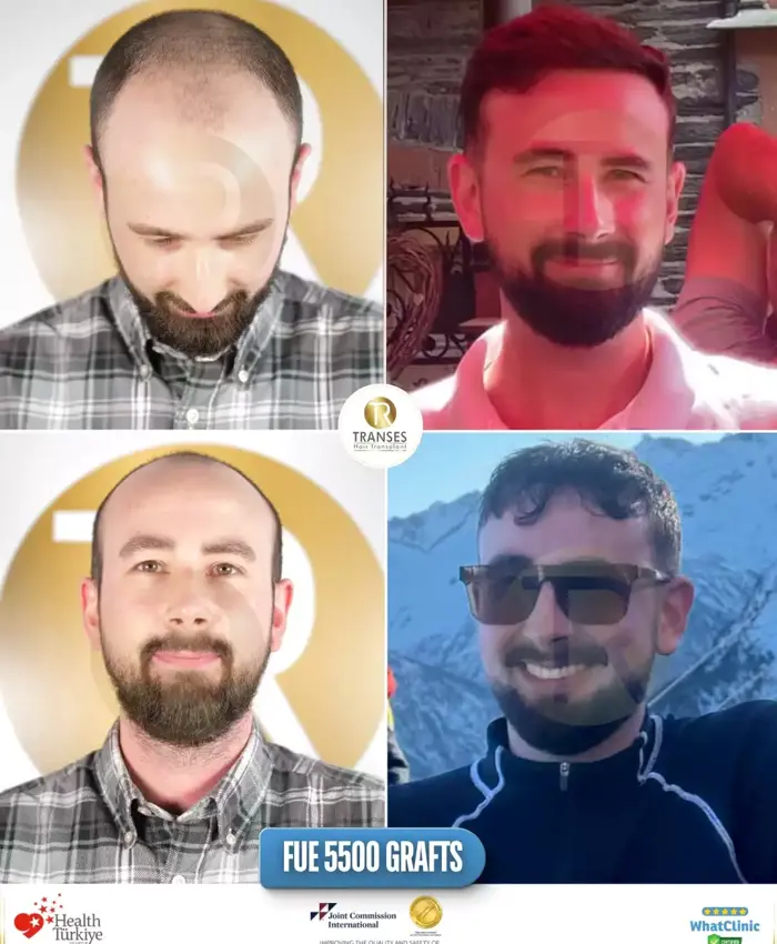 Before & After