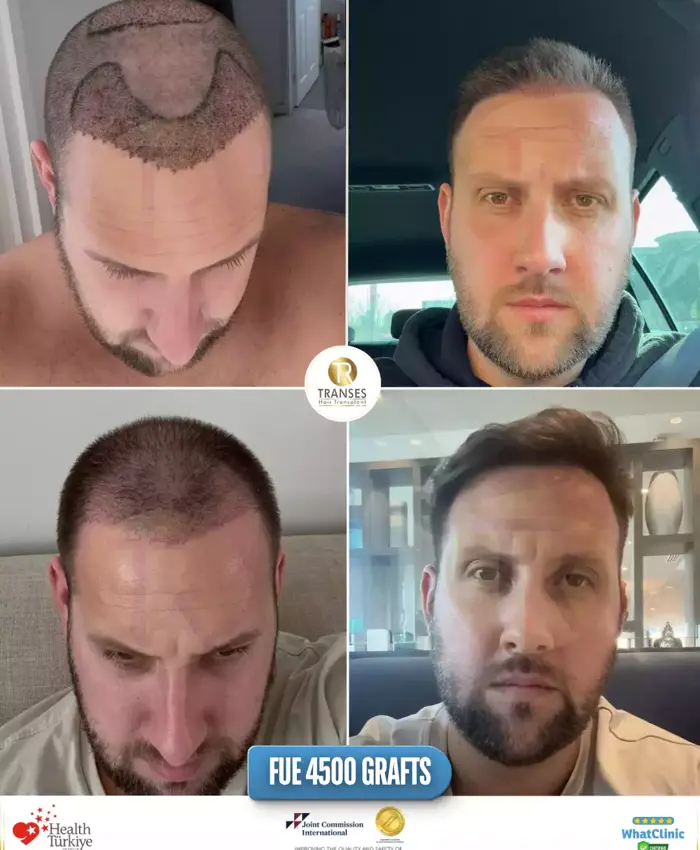 Before & After