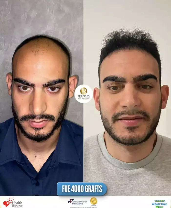 Before & After