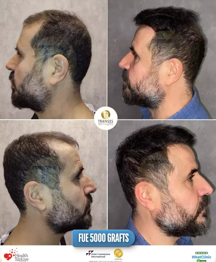 Before & After