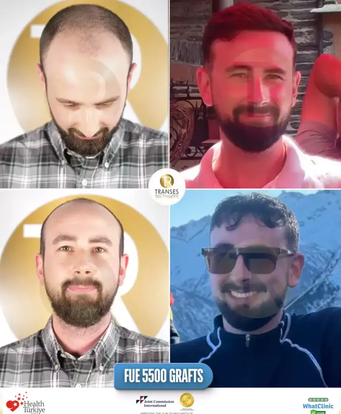 Before & After
