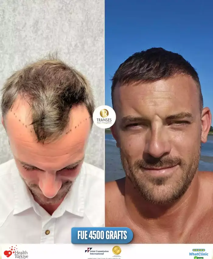 Before & After