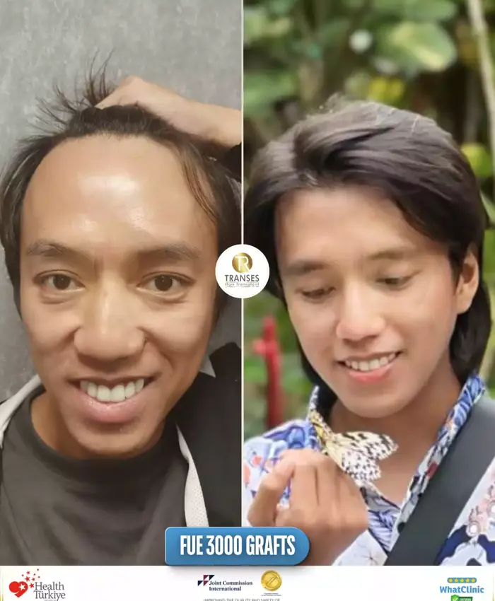 Before & After