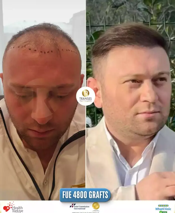 Before & After