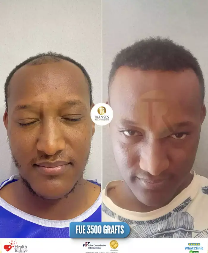 Before & After