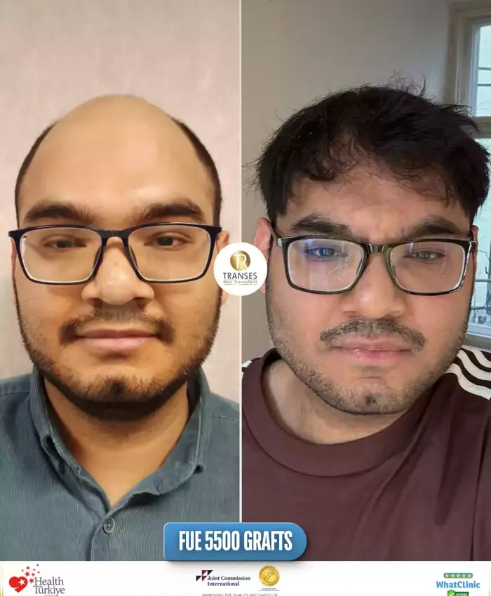 Before & After