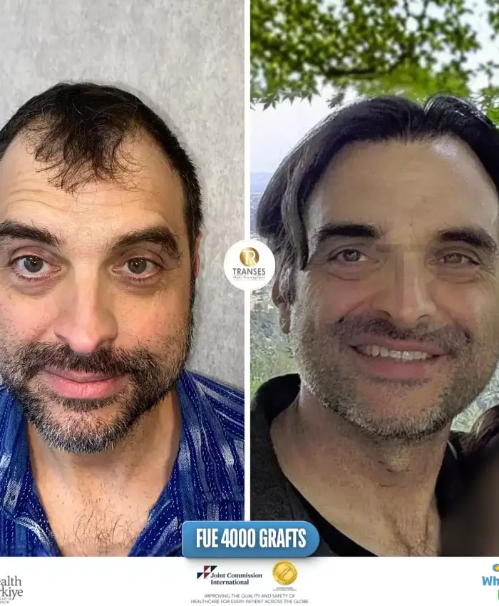 Before & After
