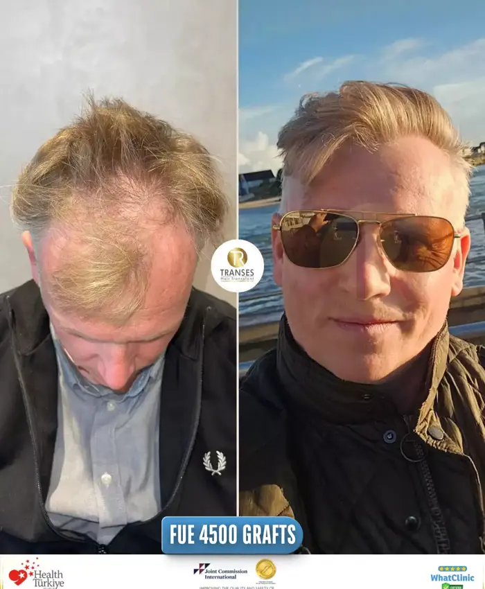 Before & After