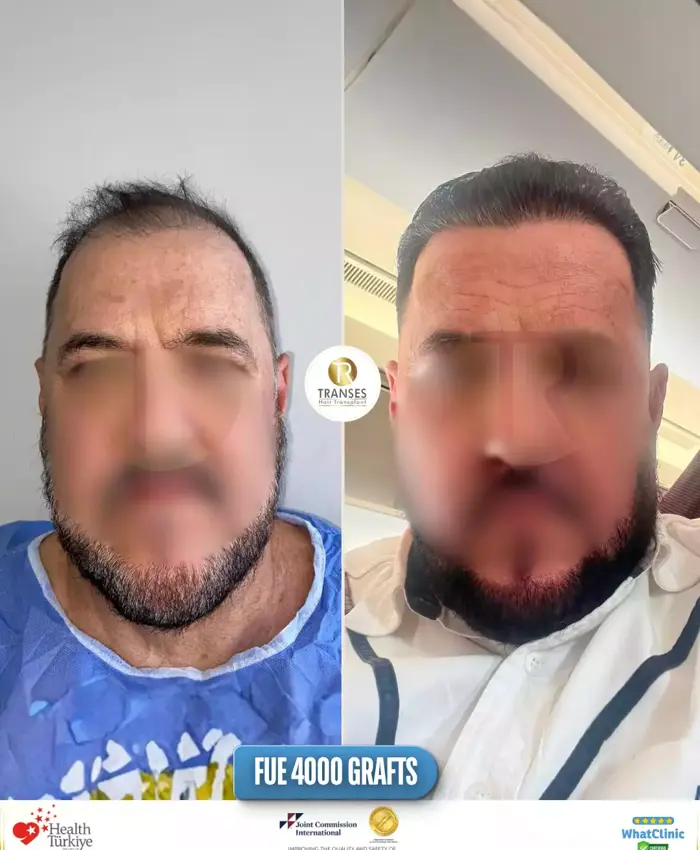 Before & After