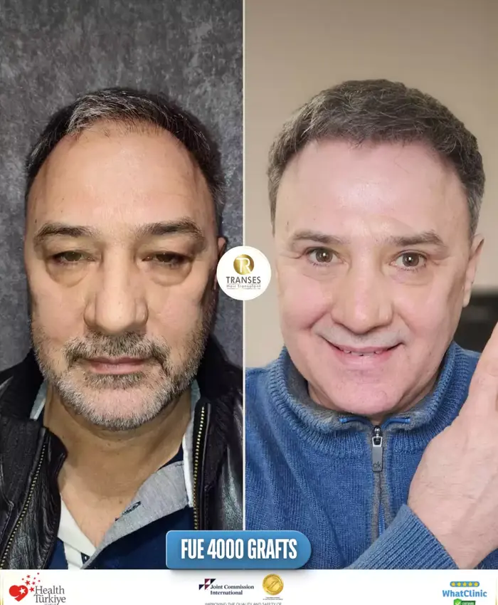 Before & After
