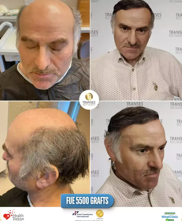 Before & After