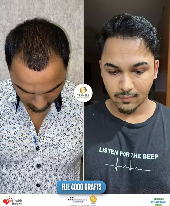 Before & After