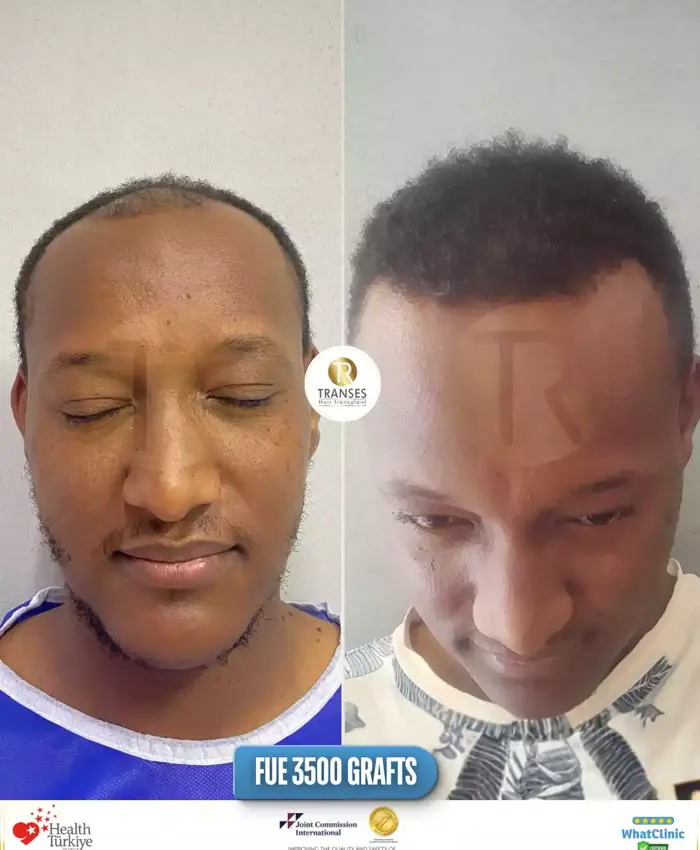 Before & After