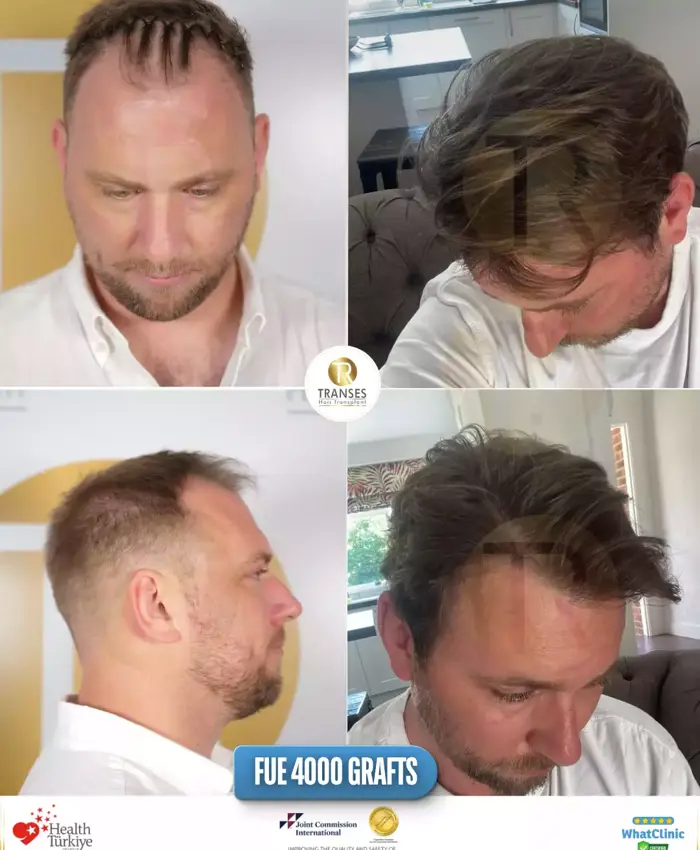 Before & After