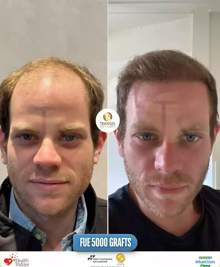 Before & After