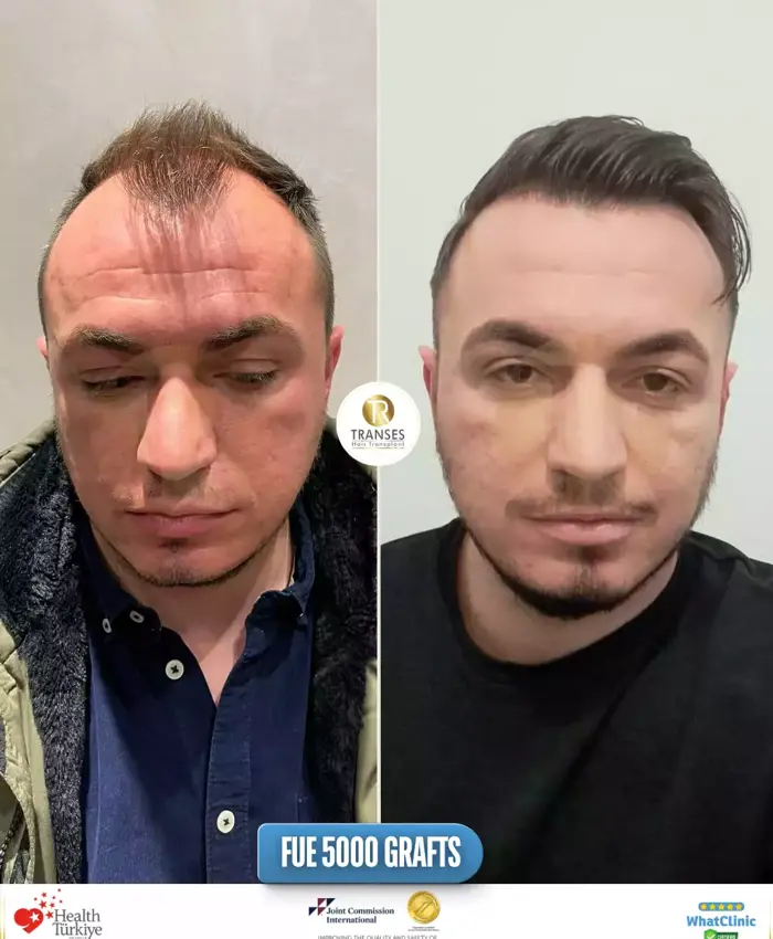 Before & After