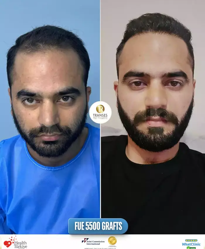 Before & After