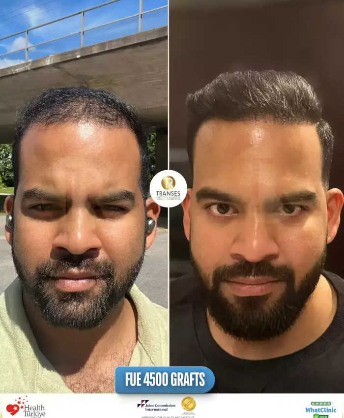 Before & After