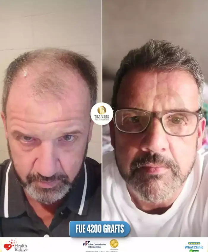 Before & After
