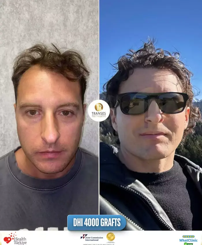 Before & After