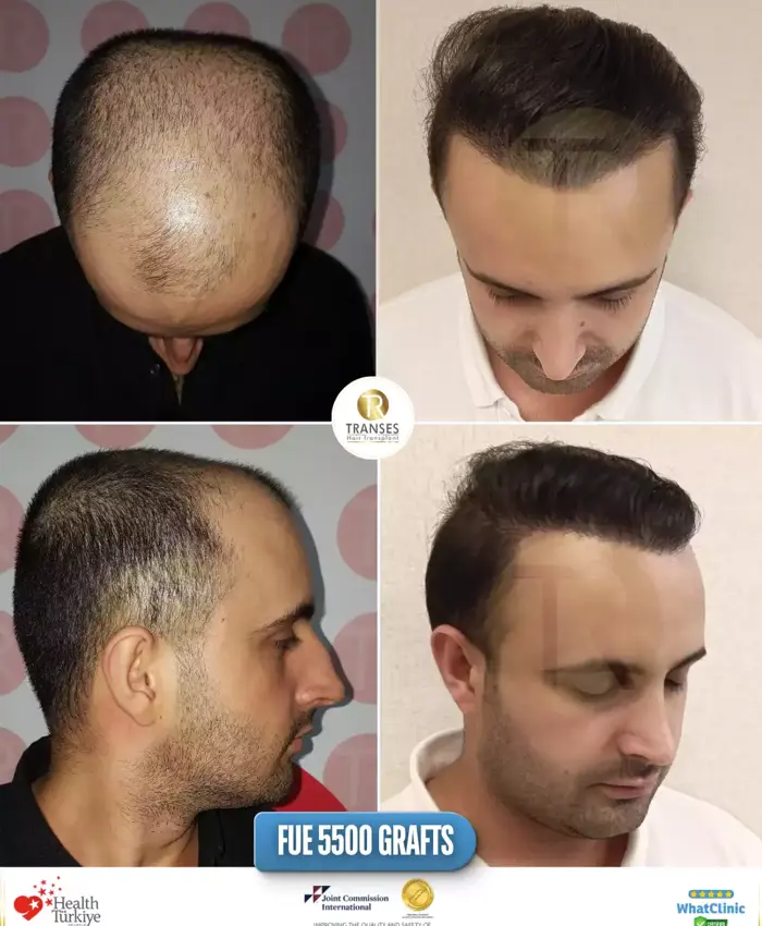 Before & After
